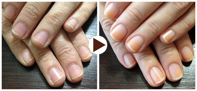 POPOlish自爪改善