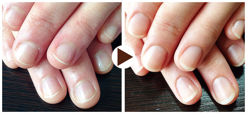 ぽぽりっしゅ自爪改善