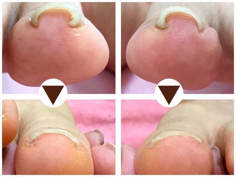 POPOlish巻き爪改善